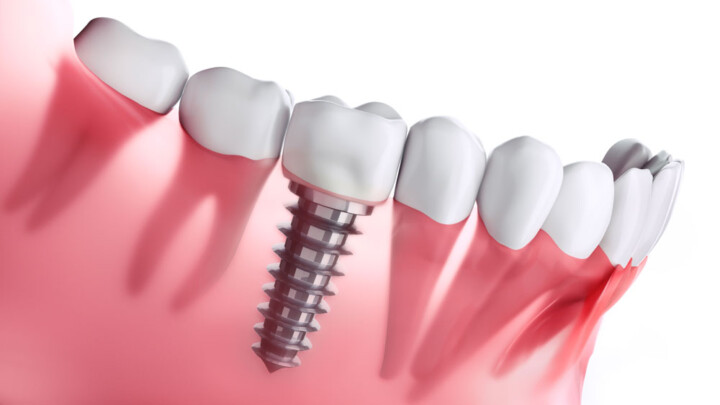 Dr Joel Tuckett Dental Implant