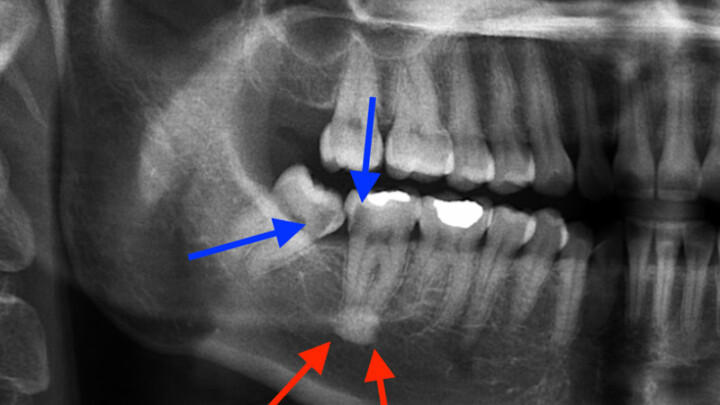 Dentoalveolar Surgery brisbane Dr Joel Tuckett