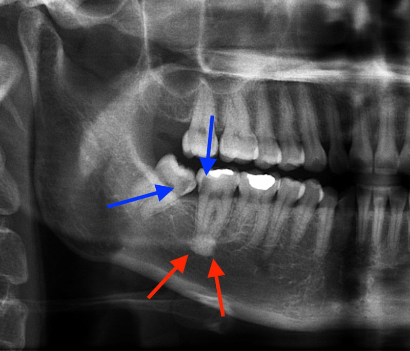 Dentoalveolar Surgery brisbane Dr Joel Tuckett