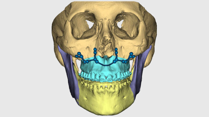 Orthognathic Surgery