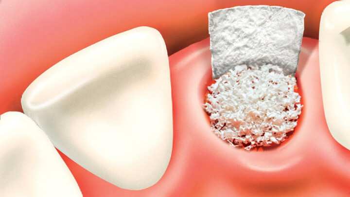 Bone Grafting surgery